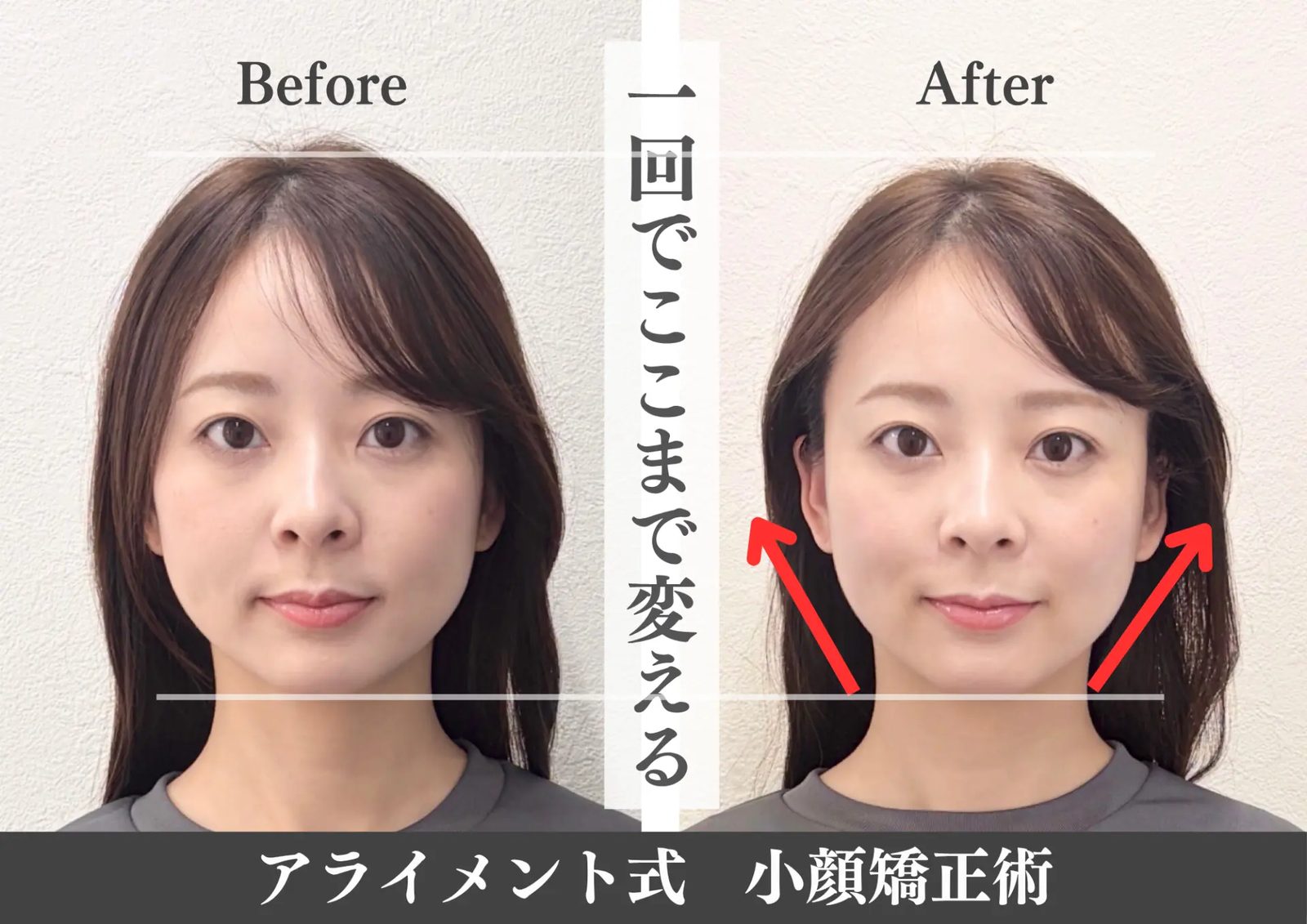 小顔矯正のBefore After — 正面・小顔｜Alignment TOKYO