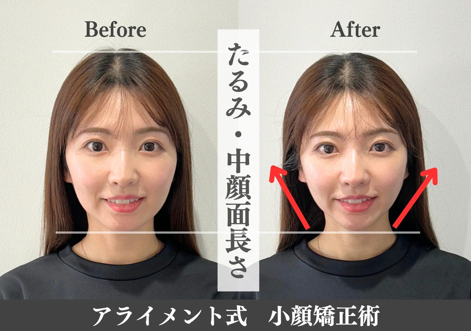 小顔矯正のBefore After — 正面・小顔｜Alignment TOKYO