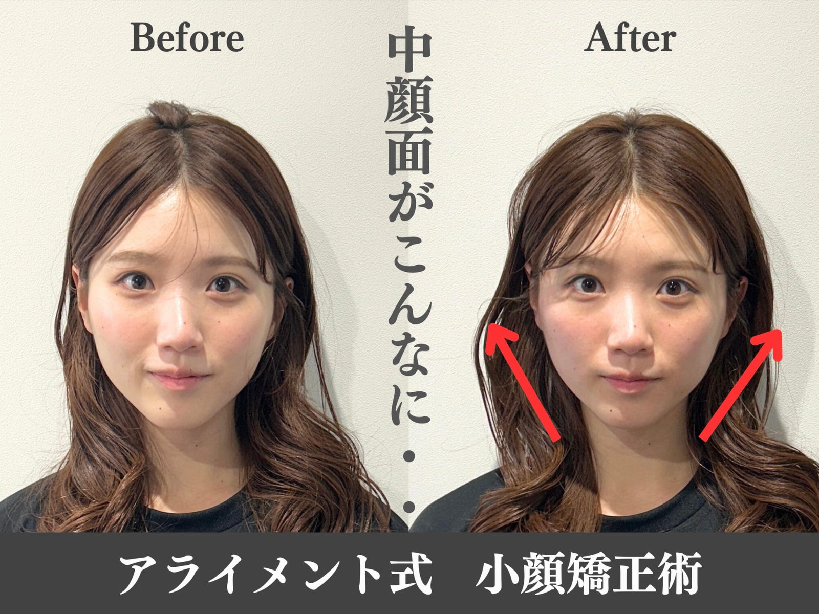 小顔矯正のBefore After — 正面・小顔｜Alignment TOKYO