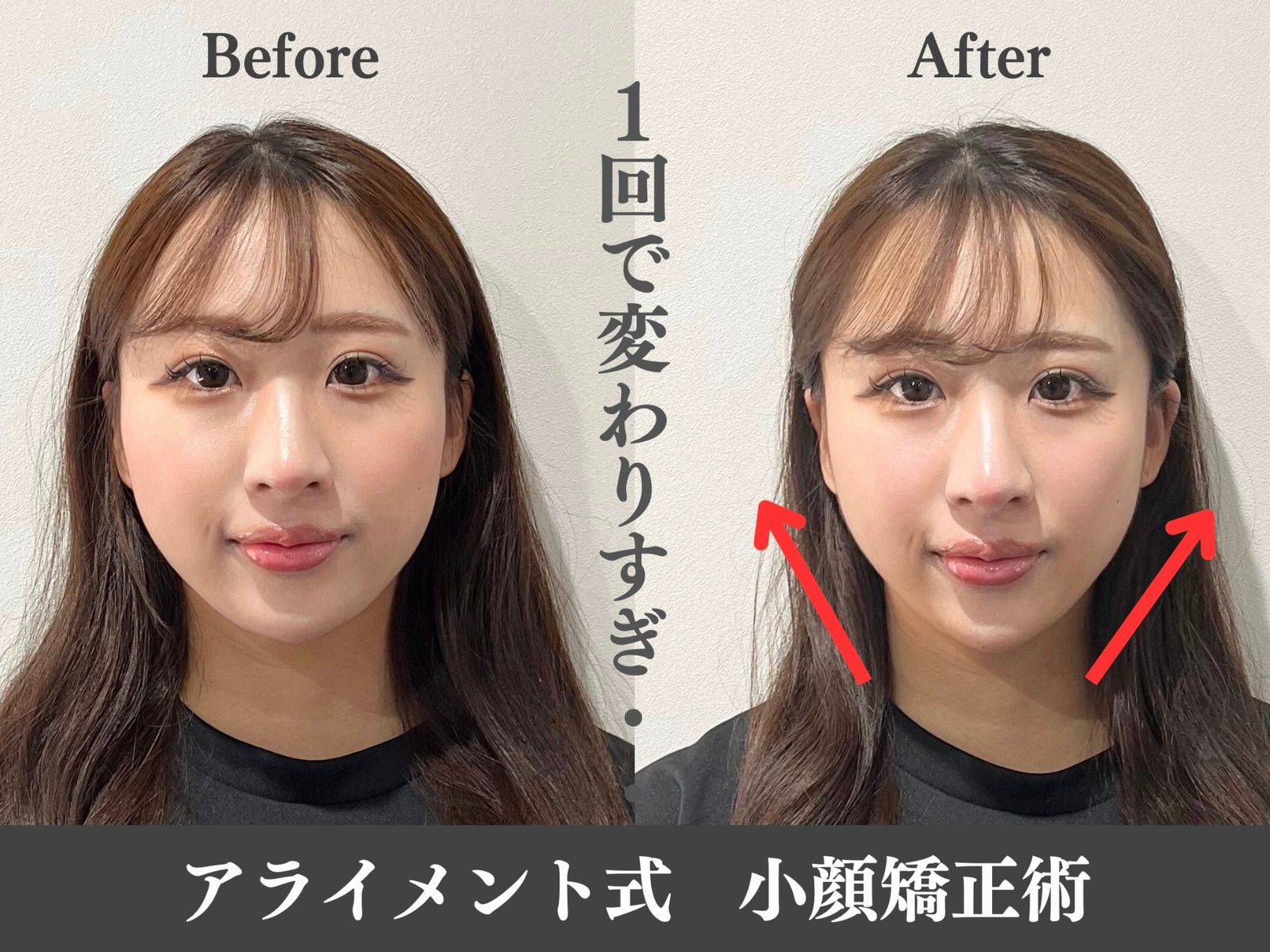 小顔矯正のBefore After — 正面・小顔｜Alignment TOKYO