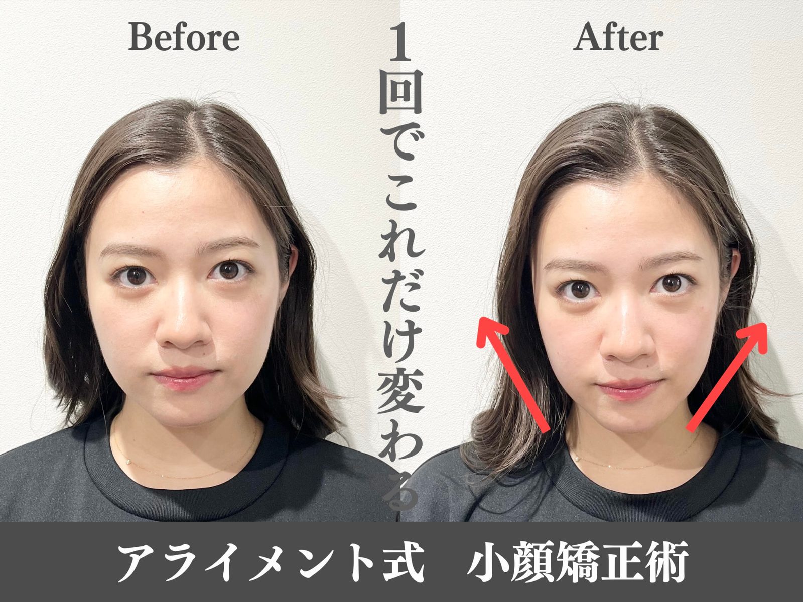 小顔矯正のBefore After — 正面・小顔｜Alignment TOKYO