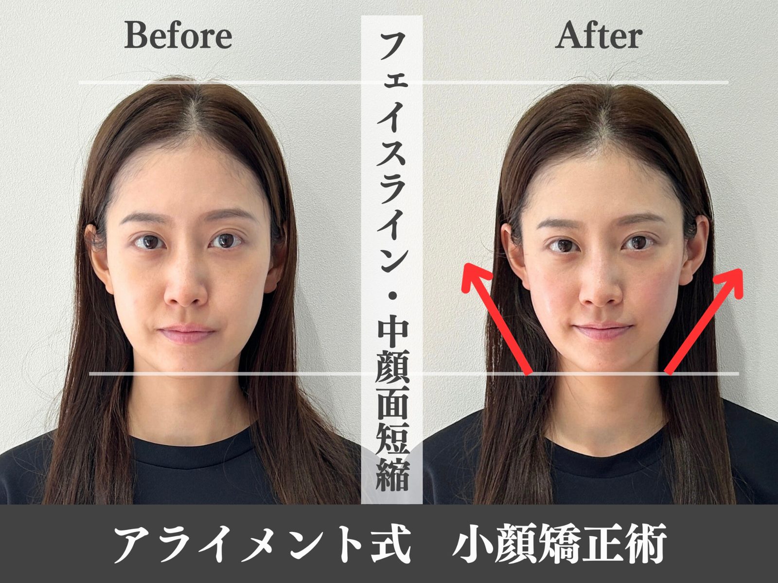 小顔矯正のBefore After — 正面・小顔｜Alignment TOKYO