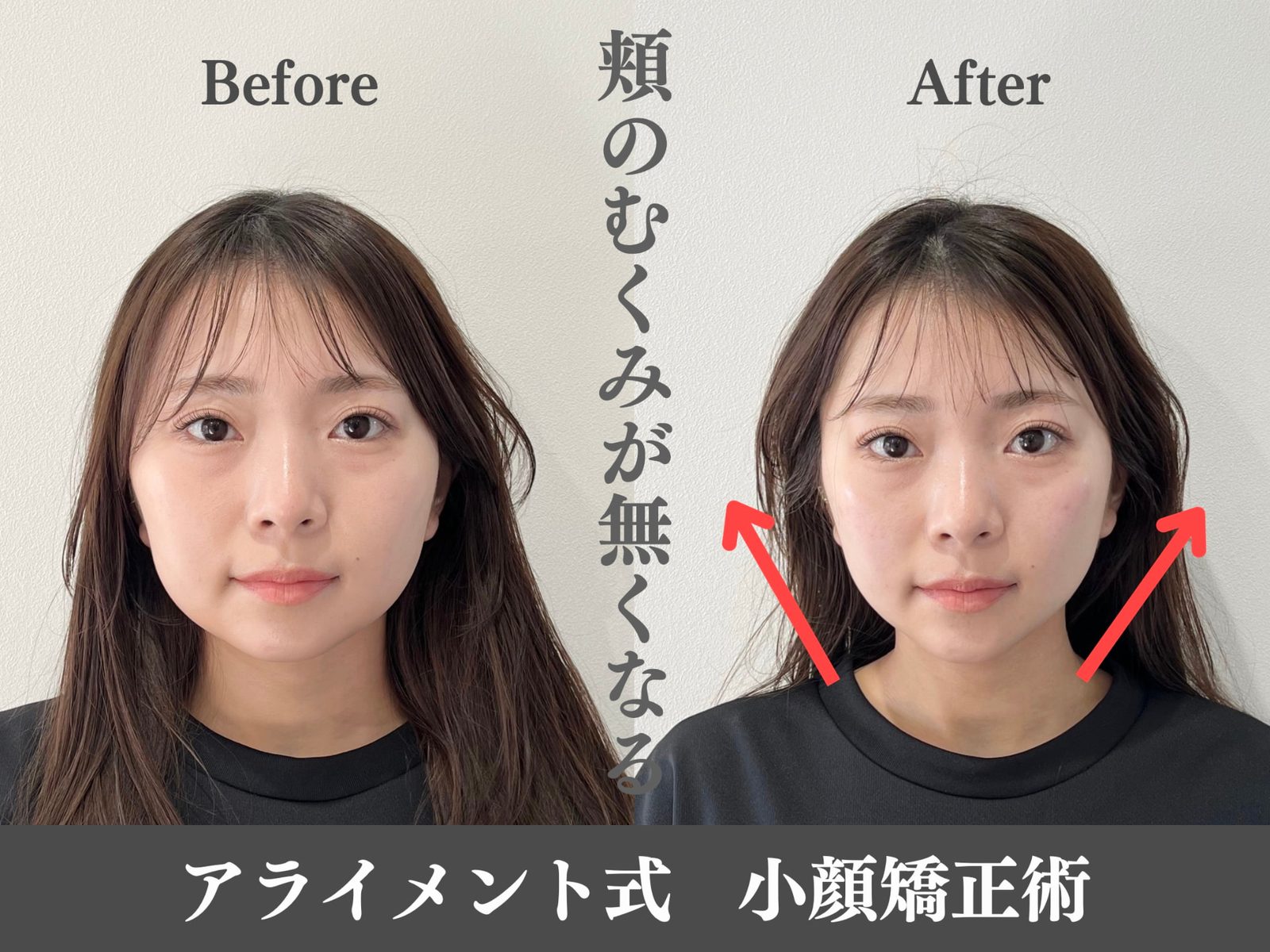 小顔矯正のBefore After — 正面・小顔｜Alignment TOKYO