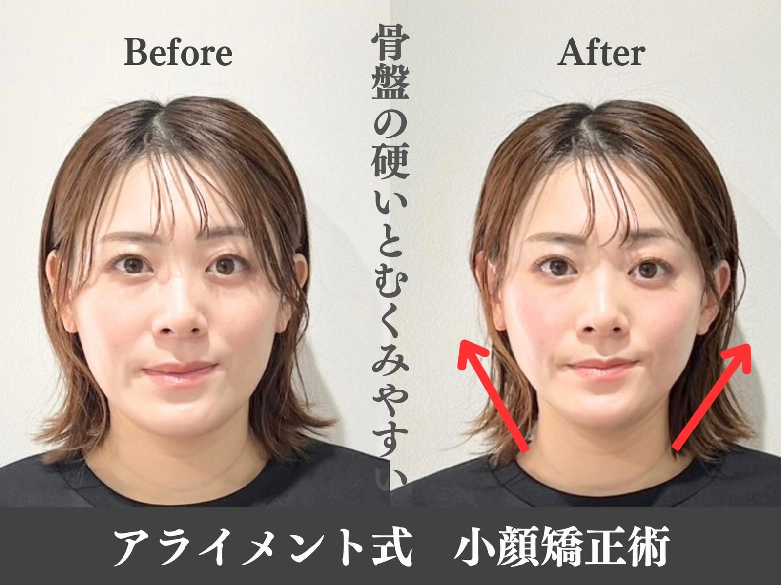 小顔矯正のBefore After — 正面・小顔｜Alignment TOKYO