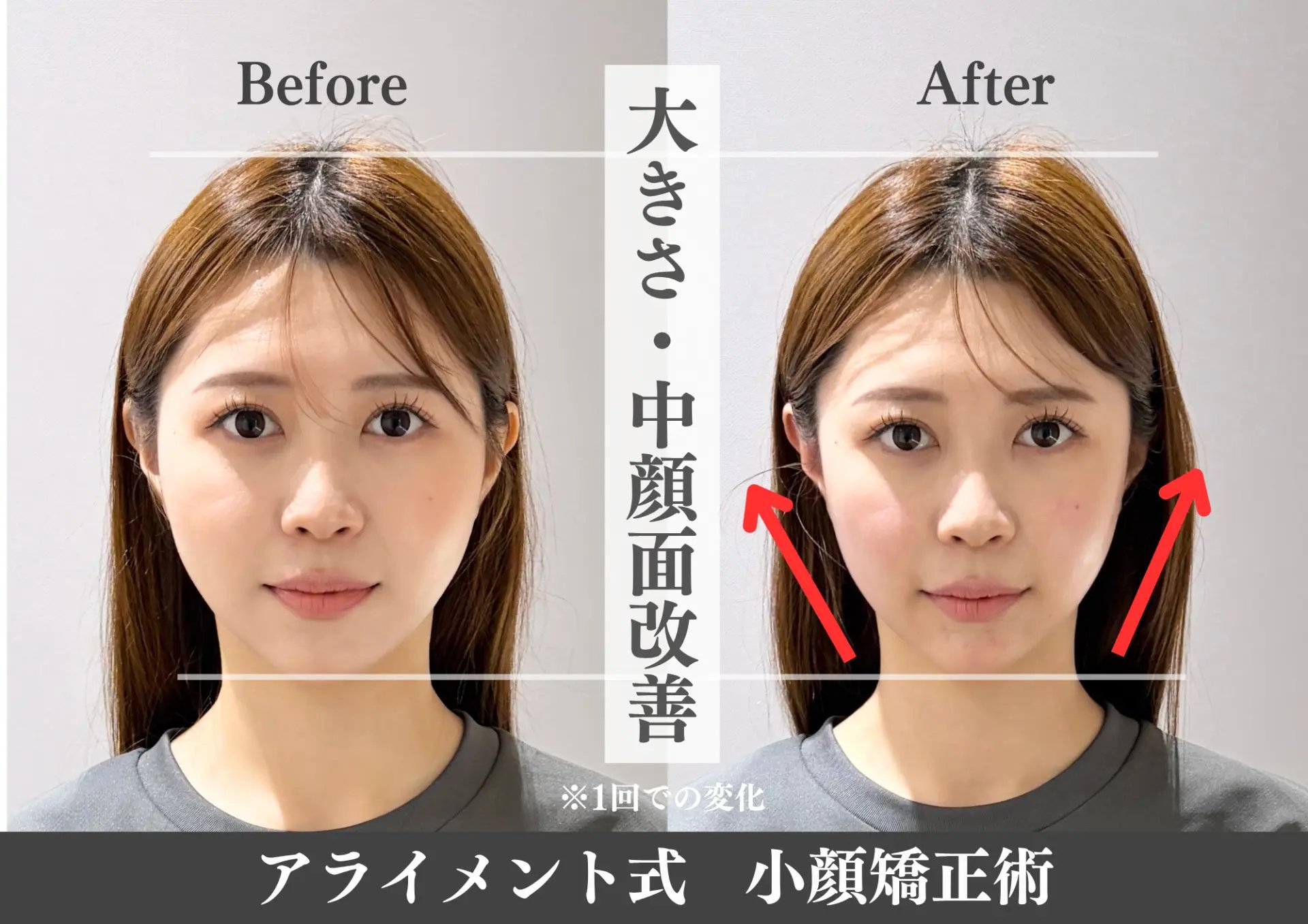 小顔矯正のBefore After — 正面・小顔｜Alignment TOKYO